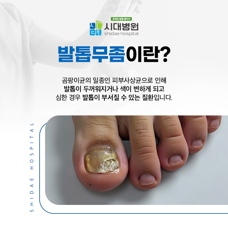 색과 두께가 달라진 발톱의 상태를 확인하는 모습