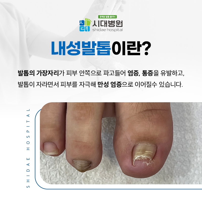발가락 주변의 발톱 상태와 피부 변화를 살펴보는 모습