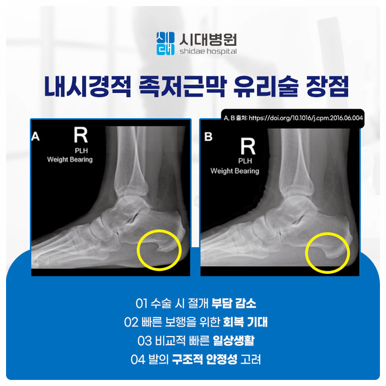 발뒤꿈치 통증에 대한 보존적 치료와 수술적 치료 방향을 안내하는 이미지