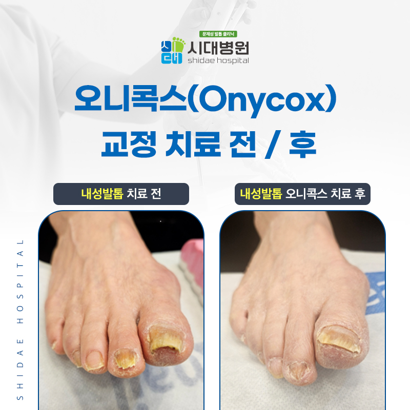발톱 형태와 진행 정도에 따라 교정 치료 방법을 살펴보는 이미지